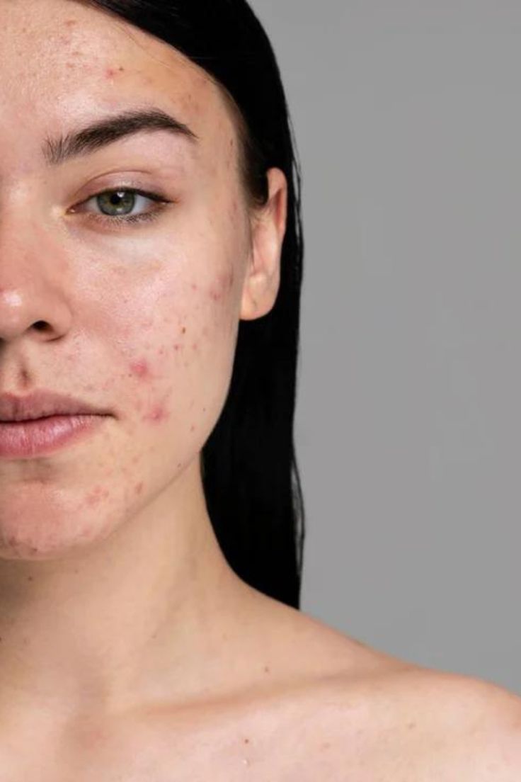 Acne treatment