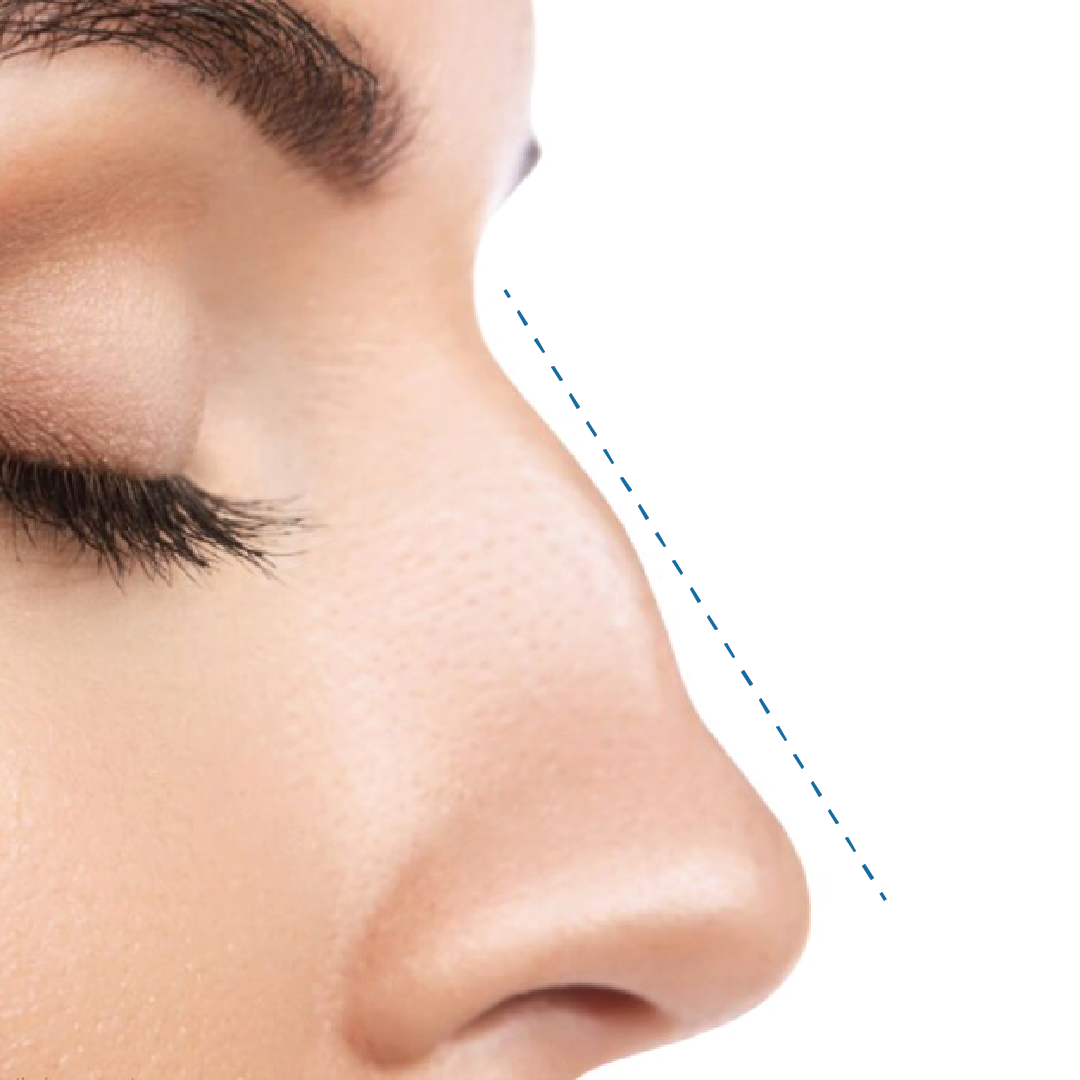 Nose correction(non-surgical)