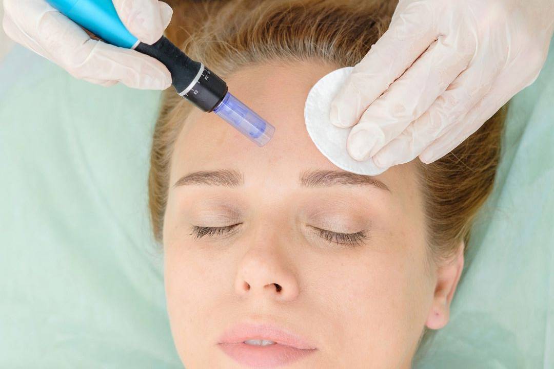 Microneedling
